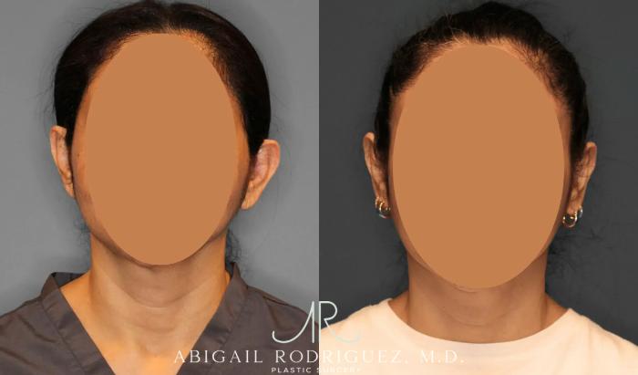 Before & After Otoplasty Case 259041 View 1 View in Houston, TX