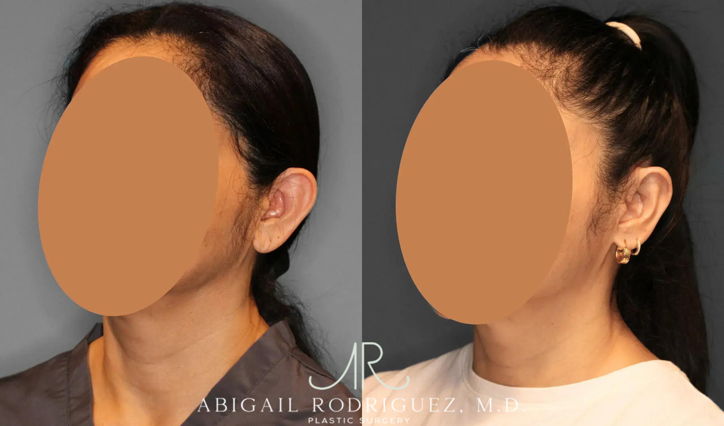 Before & After Otoplasty Case 259041 View 2 View in Houston, TX
