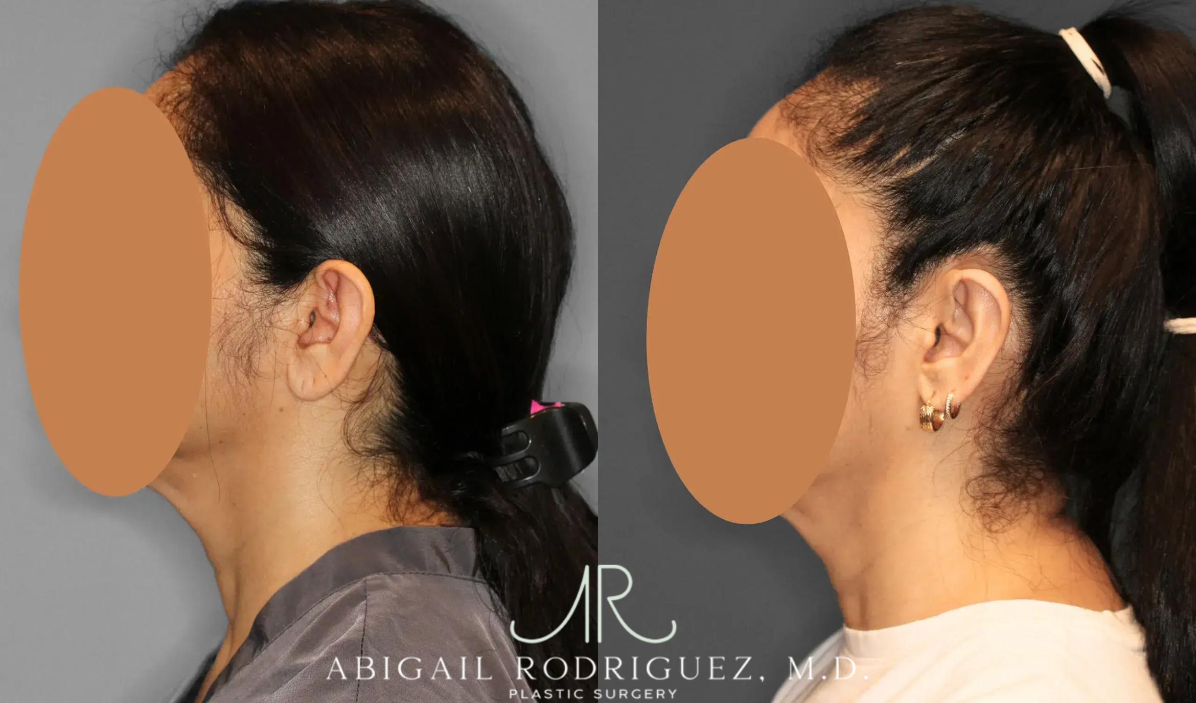 Before & After Otoplasty Case 259041 View 3 View in Houston, TX