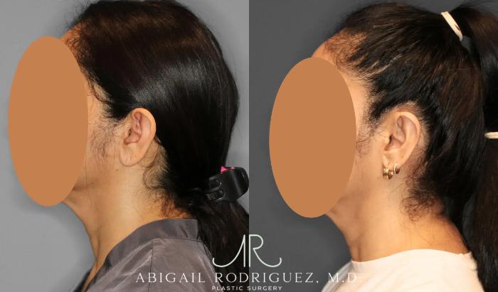 Before & After Otoplasty Case 259041 View 3 View in Houston, TX