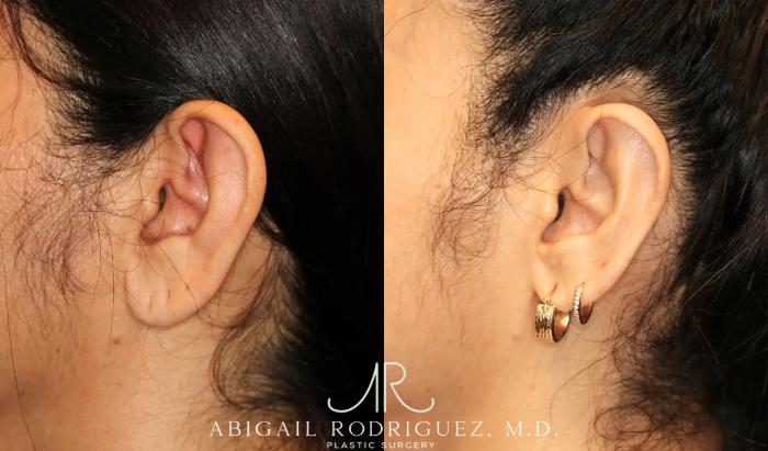 Before & After Otoplasty Case 259041 View 4 View in Houston, TX