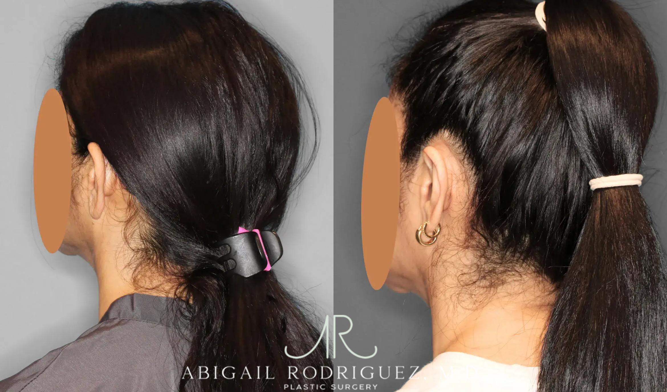 Before & After Otoplasty Case 259041 View 5 View in Houston, TX