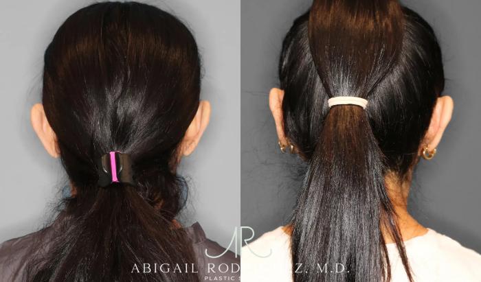 Before & After Otoplasty Case 259041 View 6 View in Houston, TX