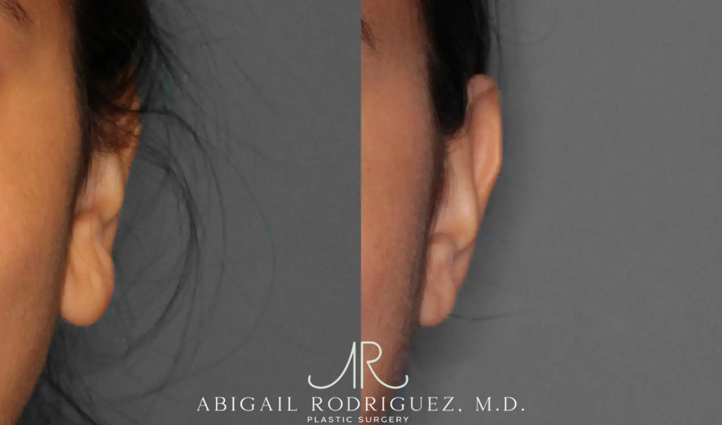 Before & After Otoplasty Case 259191 View 1 View in Houston, TX