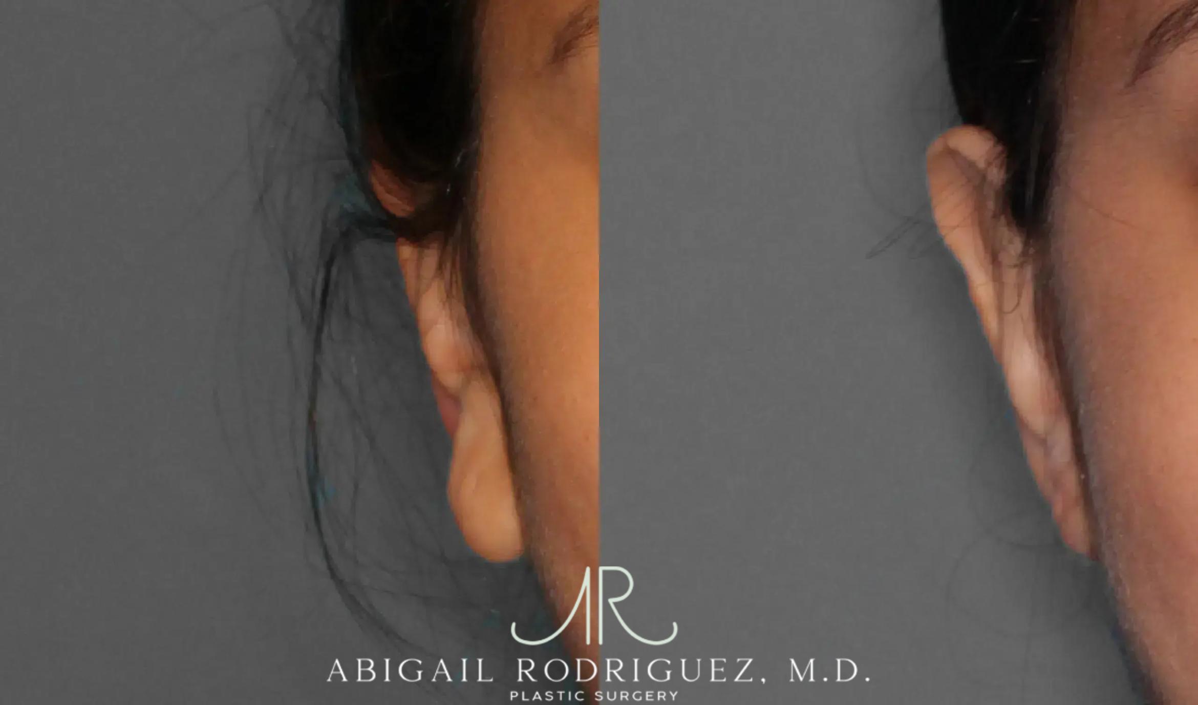 Before & After Otoplasty Case 259191 View 2 View in Houston, TX