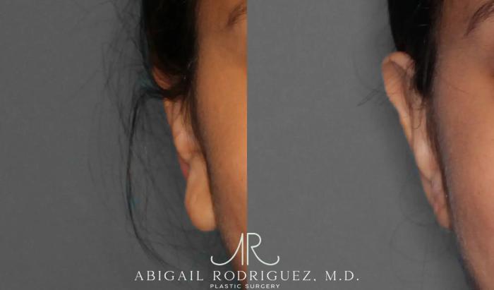 Before & After Otoplasty Case 259191 View 2 View in Houston, TX