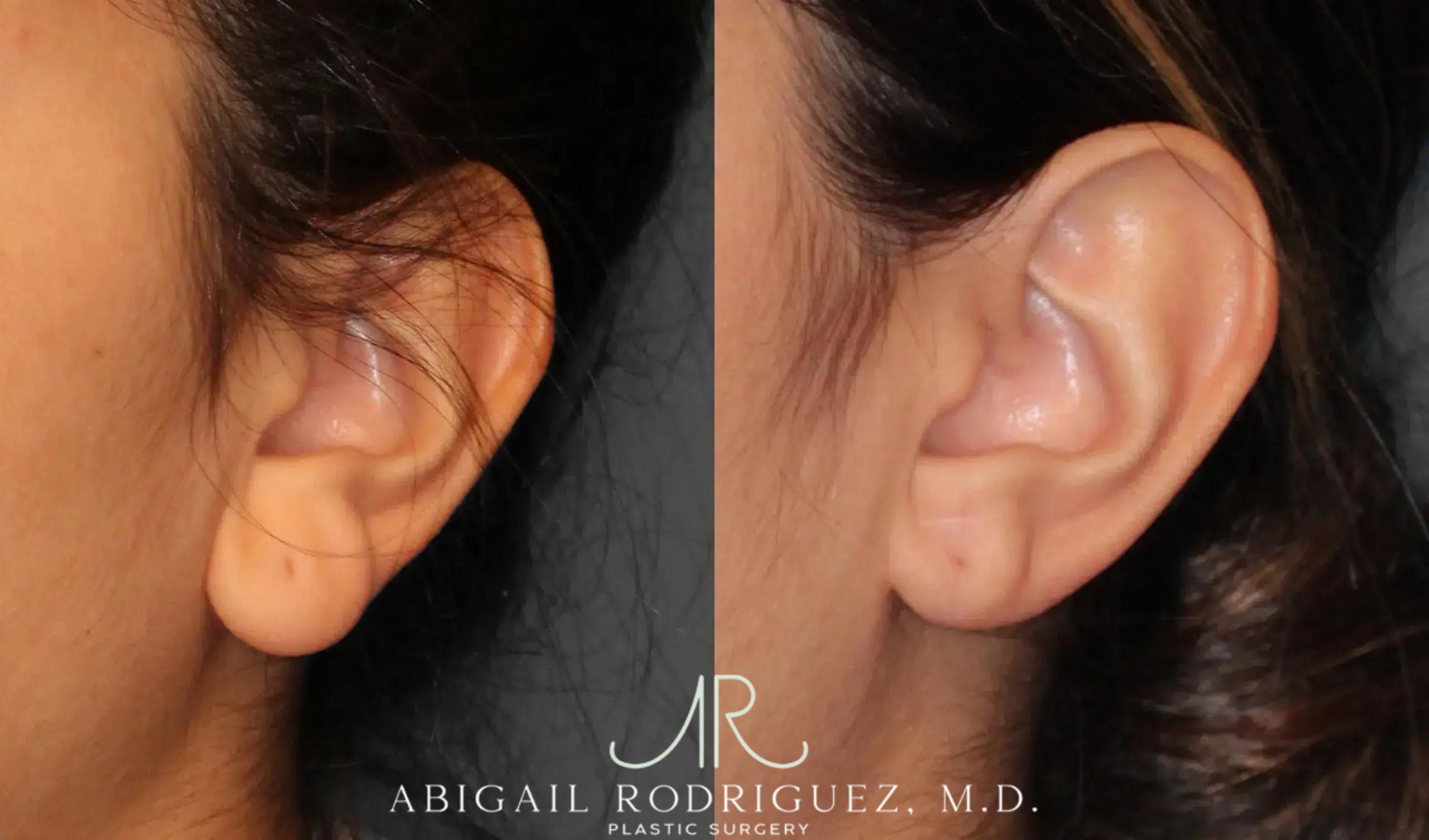 Before & After Otoplasty Case 259191 View 3 View in Houston, TX