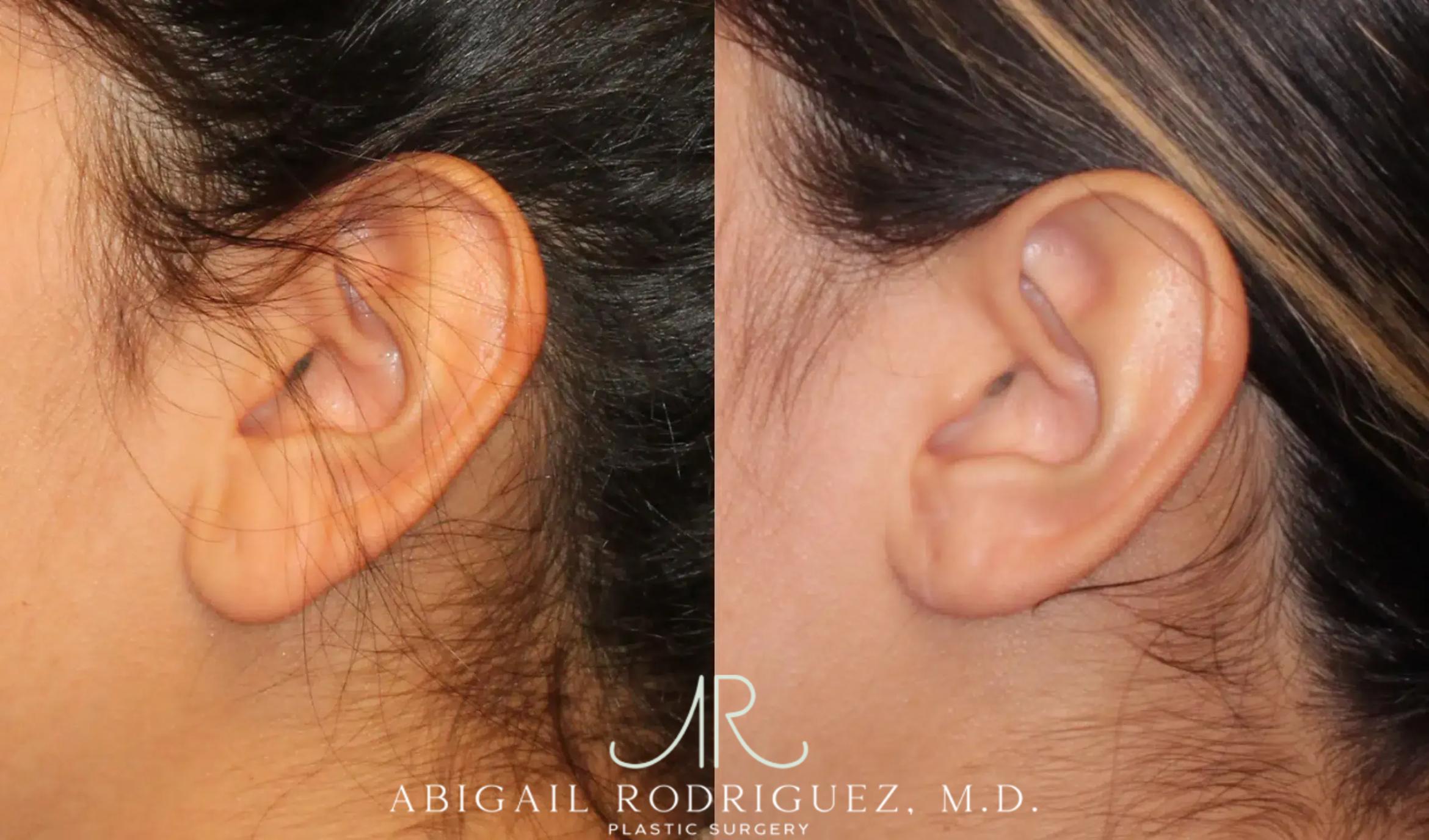 Before & After Otoplasty Case 259191 View 4 View in Houston, TX