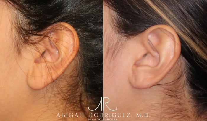 Before & After Otoplasty Case 259191 View 4 View in Houston, TX