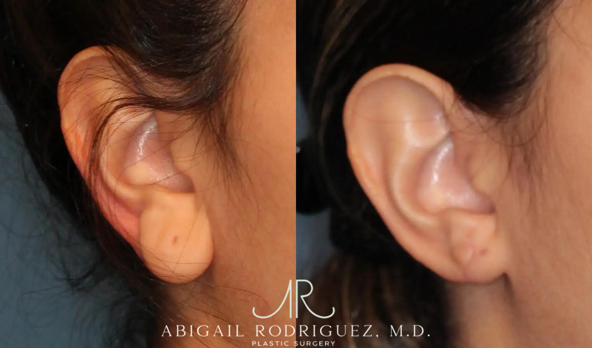 Before & After Otoplasty Case 259191 View 5 View in Houston, TX