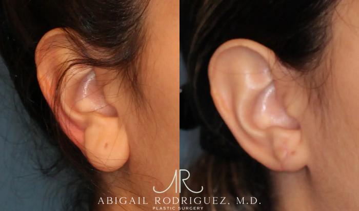 Before & After Otoplasty Case 259191 View 5 View in Houston, TX