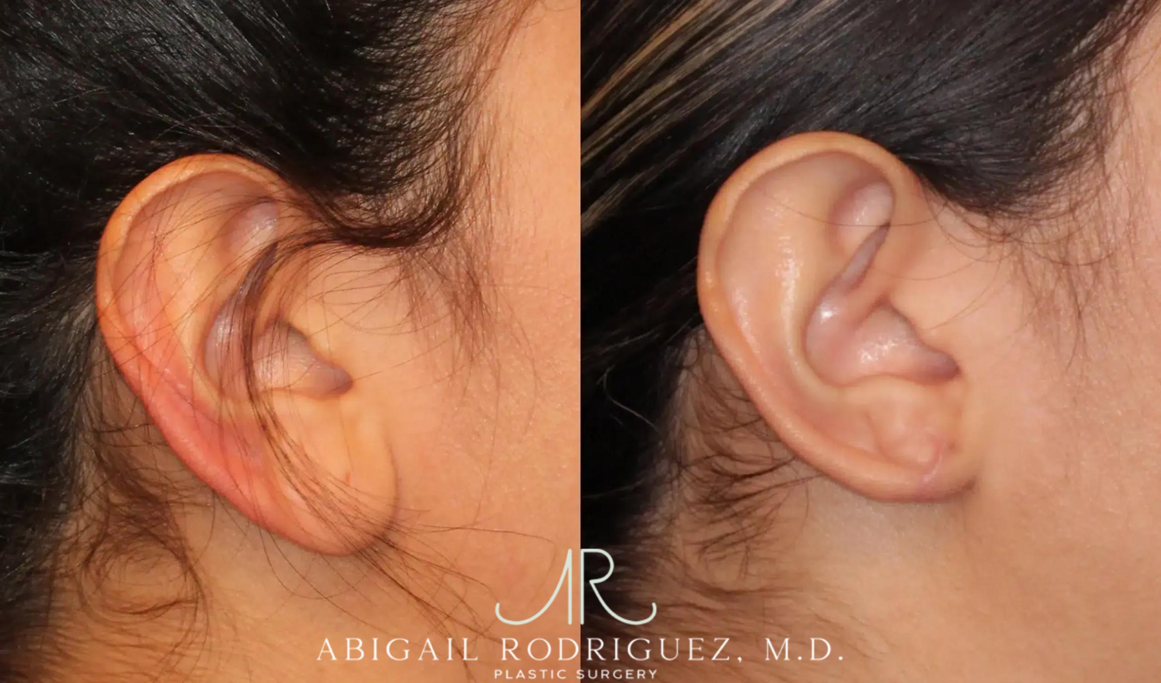 Before & After Otoplasty Case 259191 View 6 View in Houston, TX