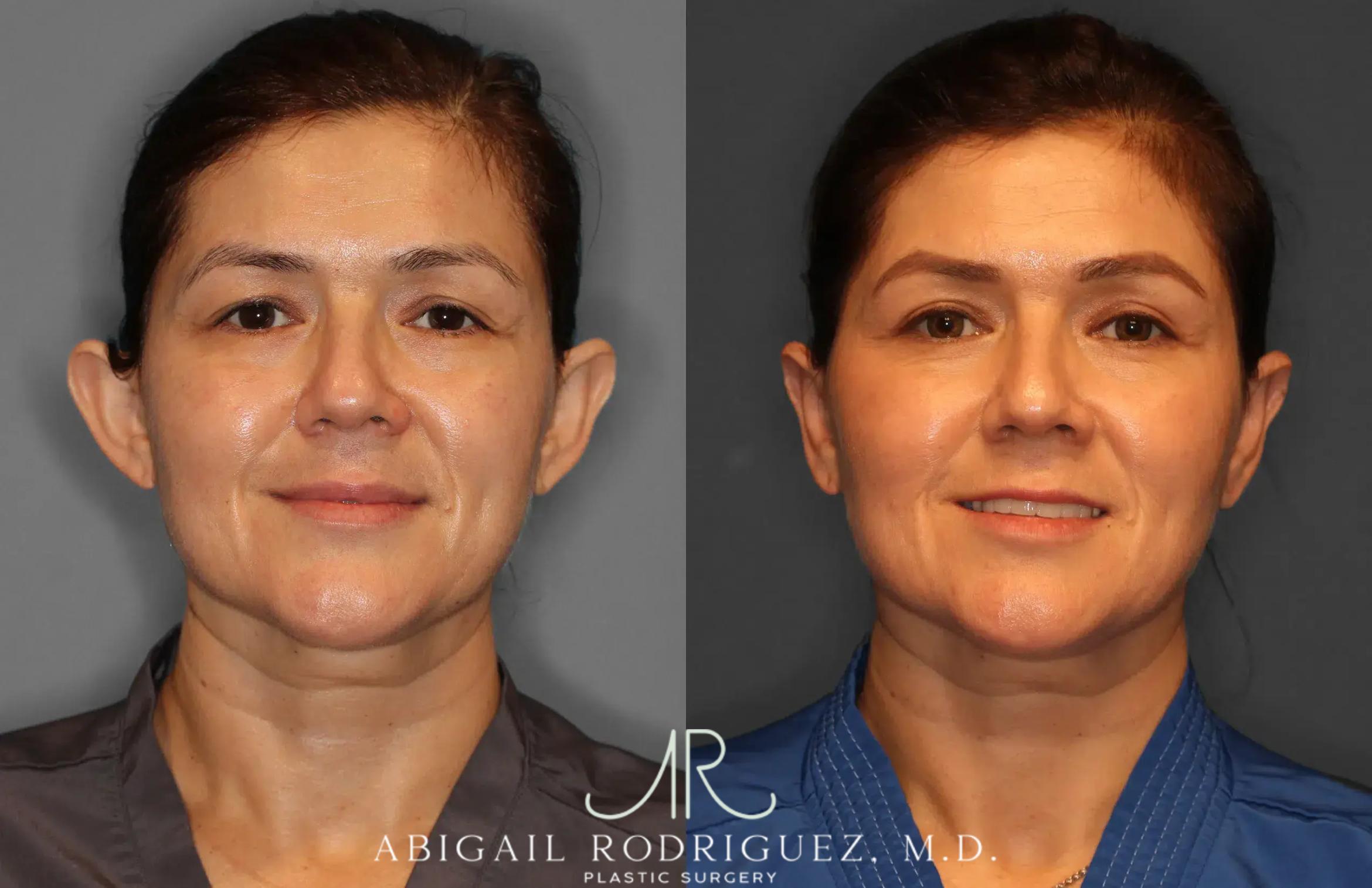Before & After Otoplasty Case 259265 View 1 View in Houston, TX