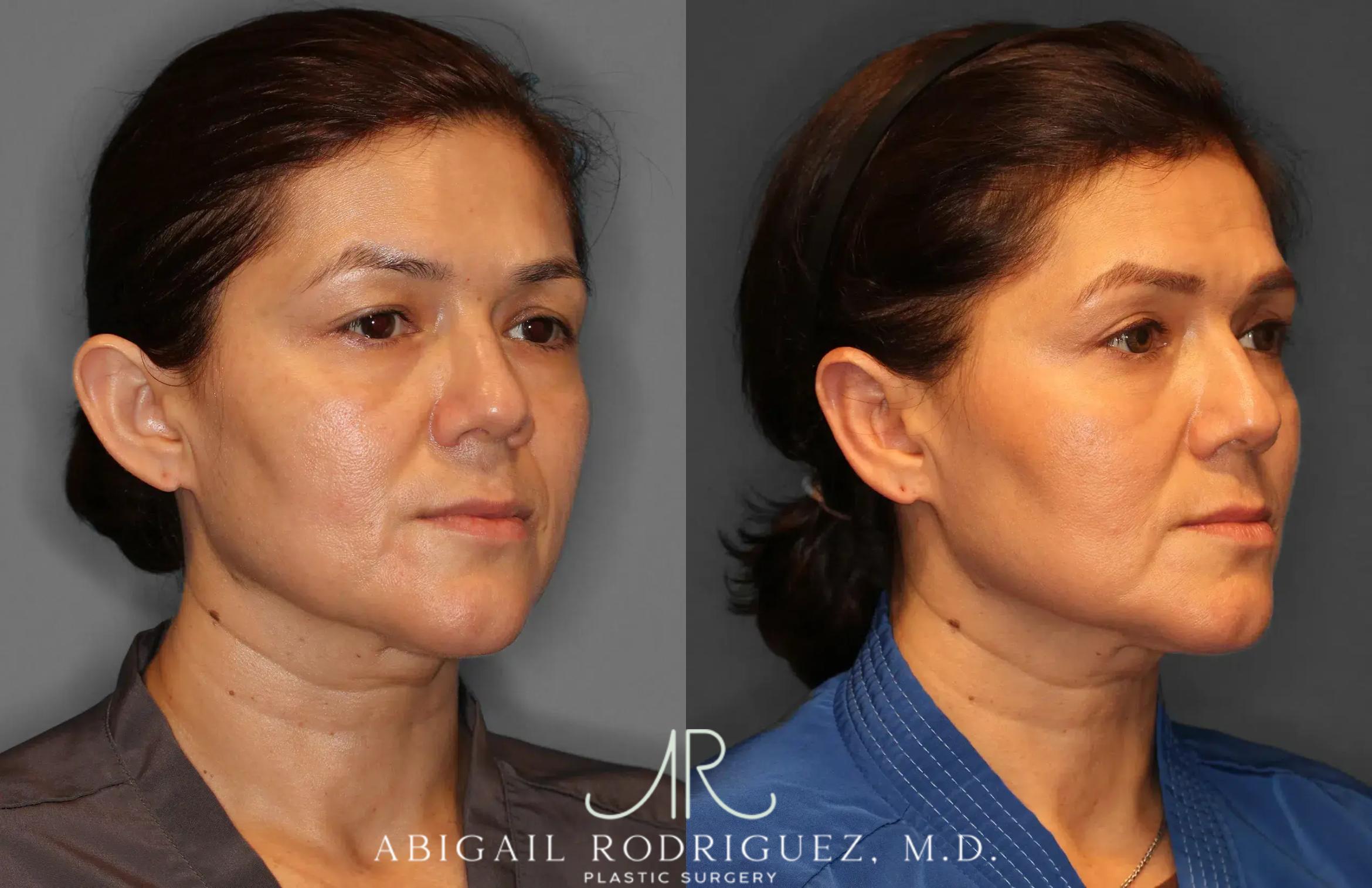 Before & After Otoplasty Case 259265 View 10 View in Houston, TX