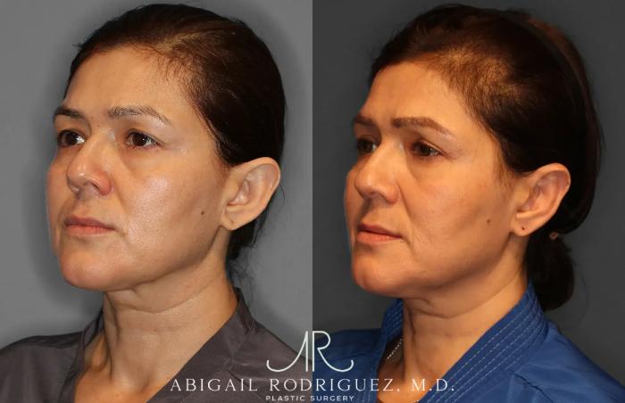 Before & After Otoplasty Case 259265 View 2 View in Houston, TX