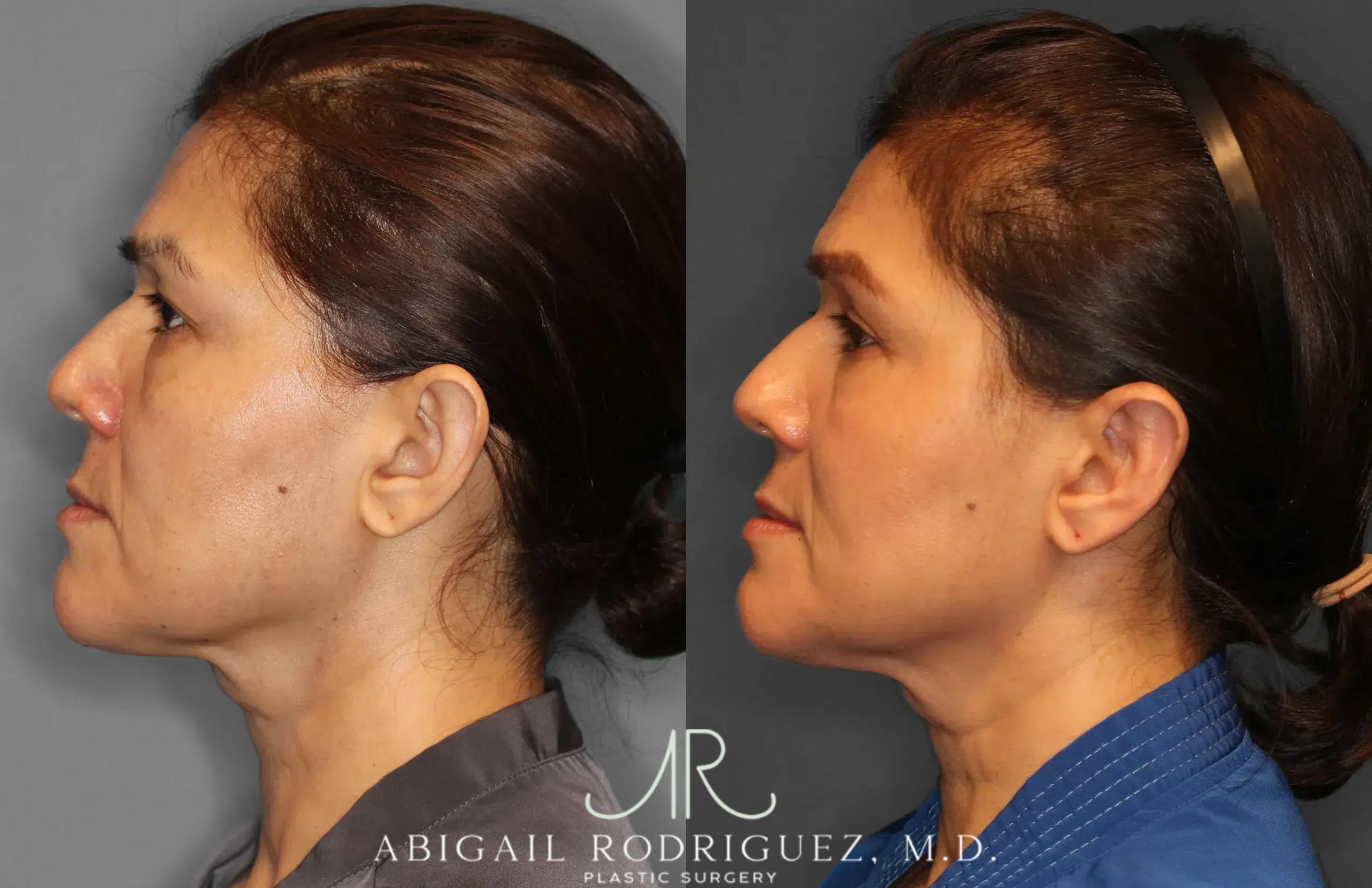 Before & After Otoplasty Case 259265 View 3 View in Houston, TX