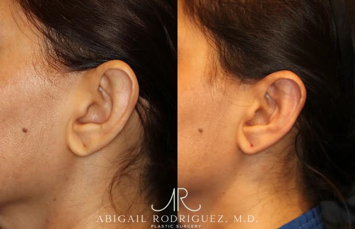 Before & After Otoplasty Case 259265 View 4 View in Houston, TX