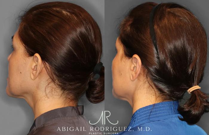 Before & After Otoplasty Case 259265 View 5 View in Houston, TX