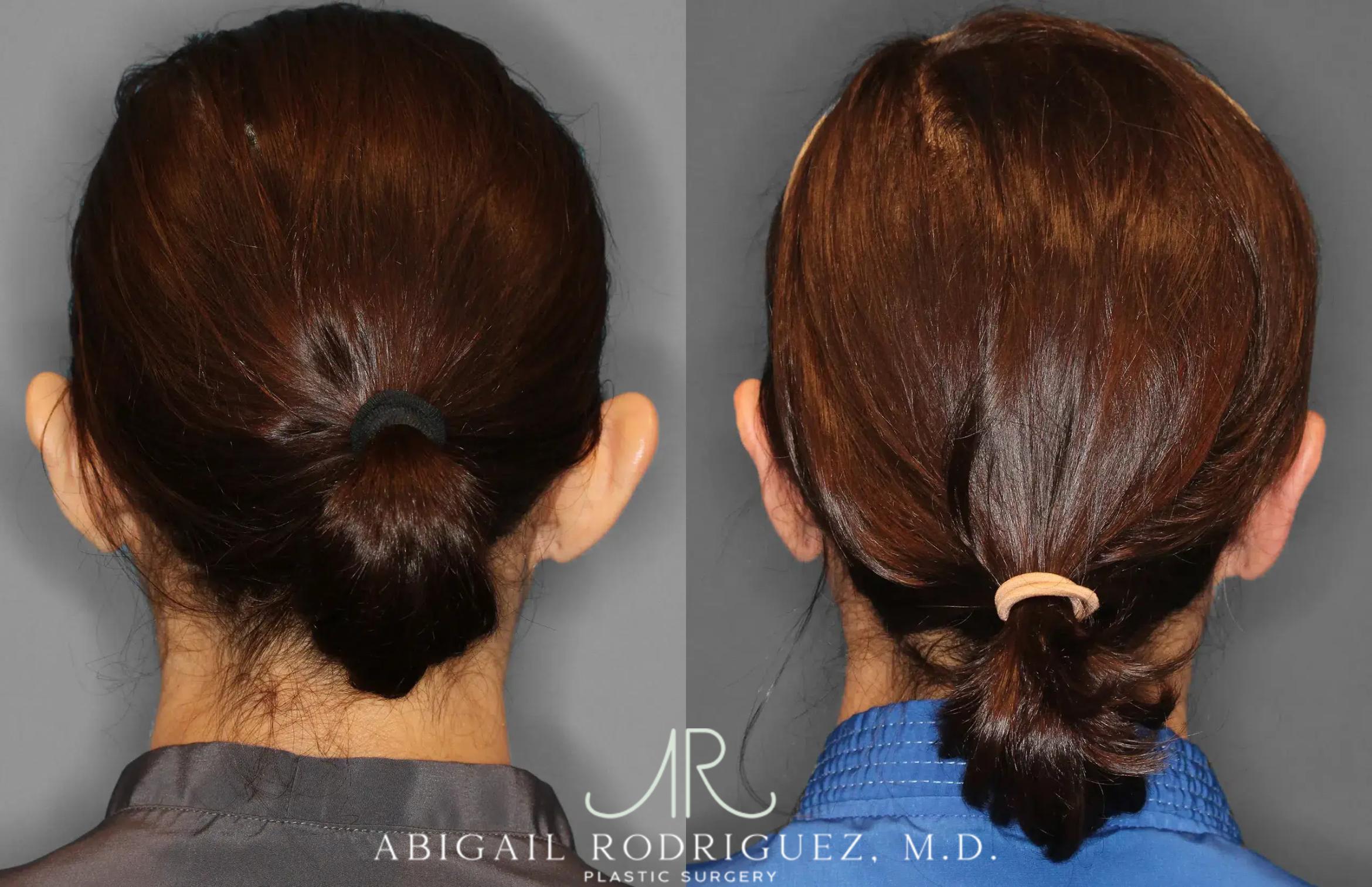 Before & After Otoplasty Case 259265 View 6 View in Houston, TX