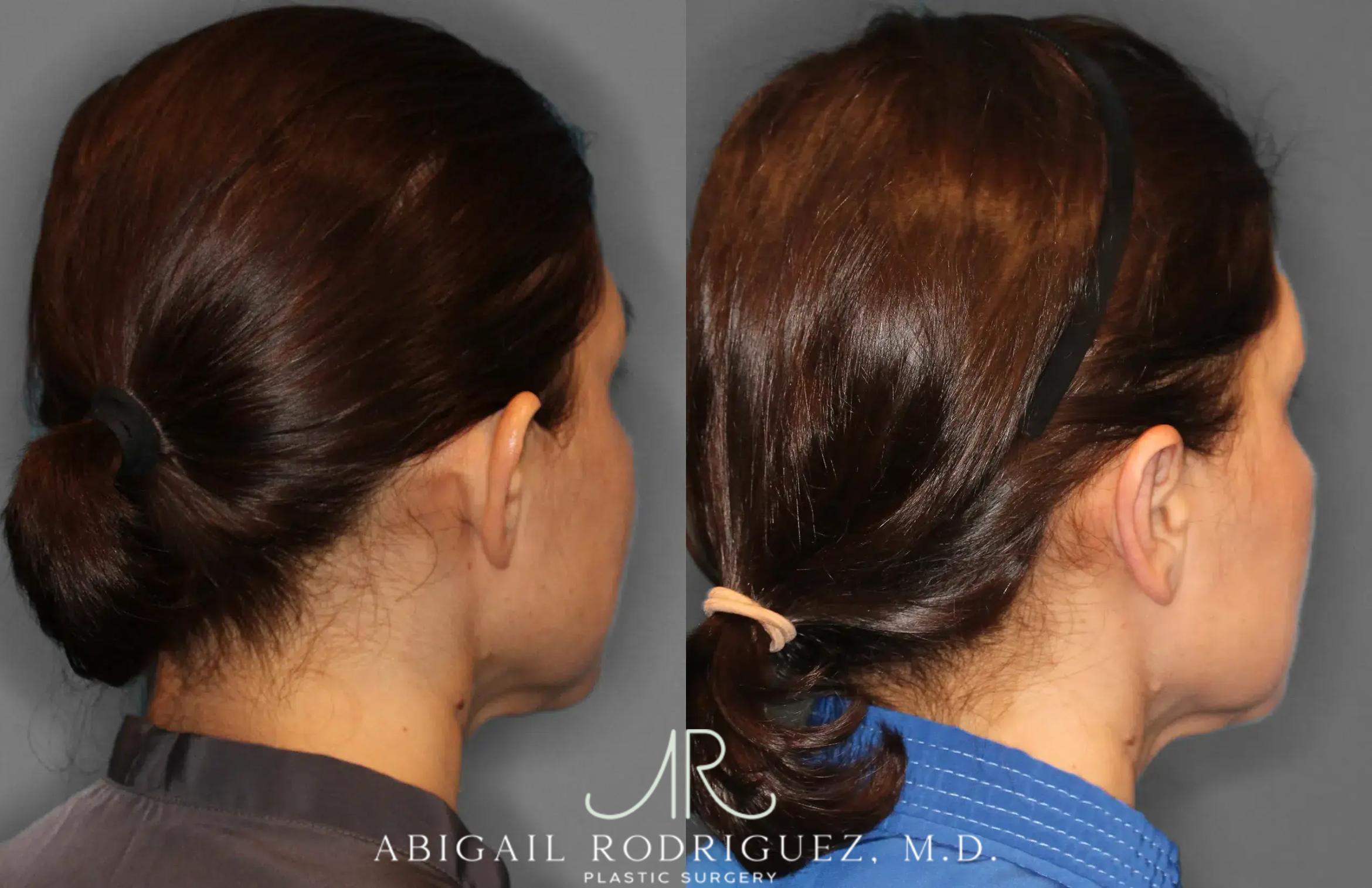 Before & After Otoplasty Case 259265 View 7 View in Houston, TX