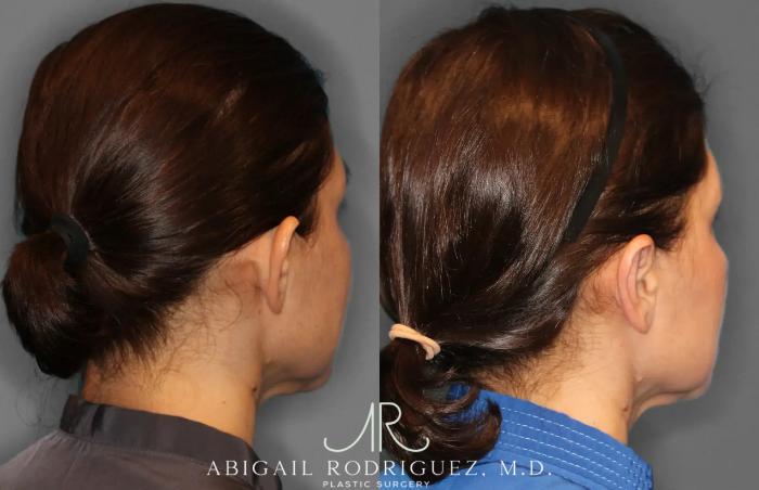 Before & After Otoplasty Case 259265 View 7 View in Houston, TX