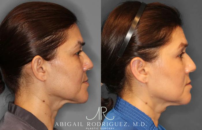 Before & After Otoplasty Case 259265 View 8 View in Houston, TX