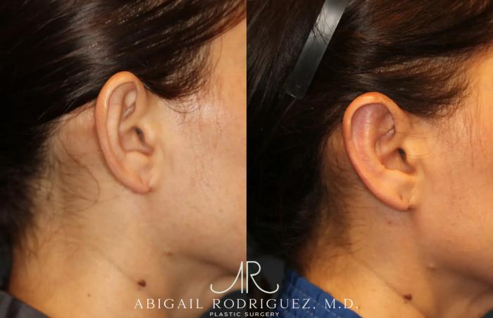 Before & After Otoplasty Case 259265 View 9 View in Houston, TX