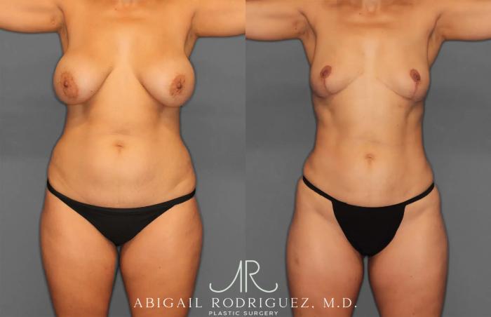 Before & After Renuvion Case 259218 View 1 View in Houston, TX