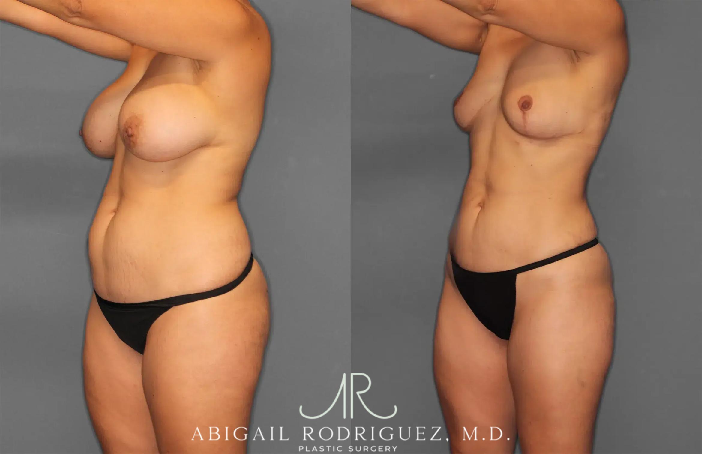 Before & After Renuvion Case 259218 View 2 View in Houston, TX