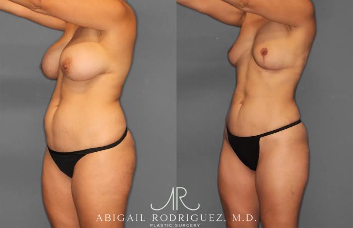 Before & After Renuvion Case 259218 View 2 View in Houston, TX