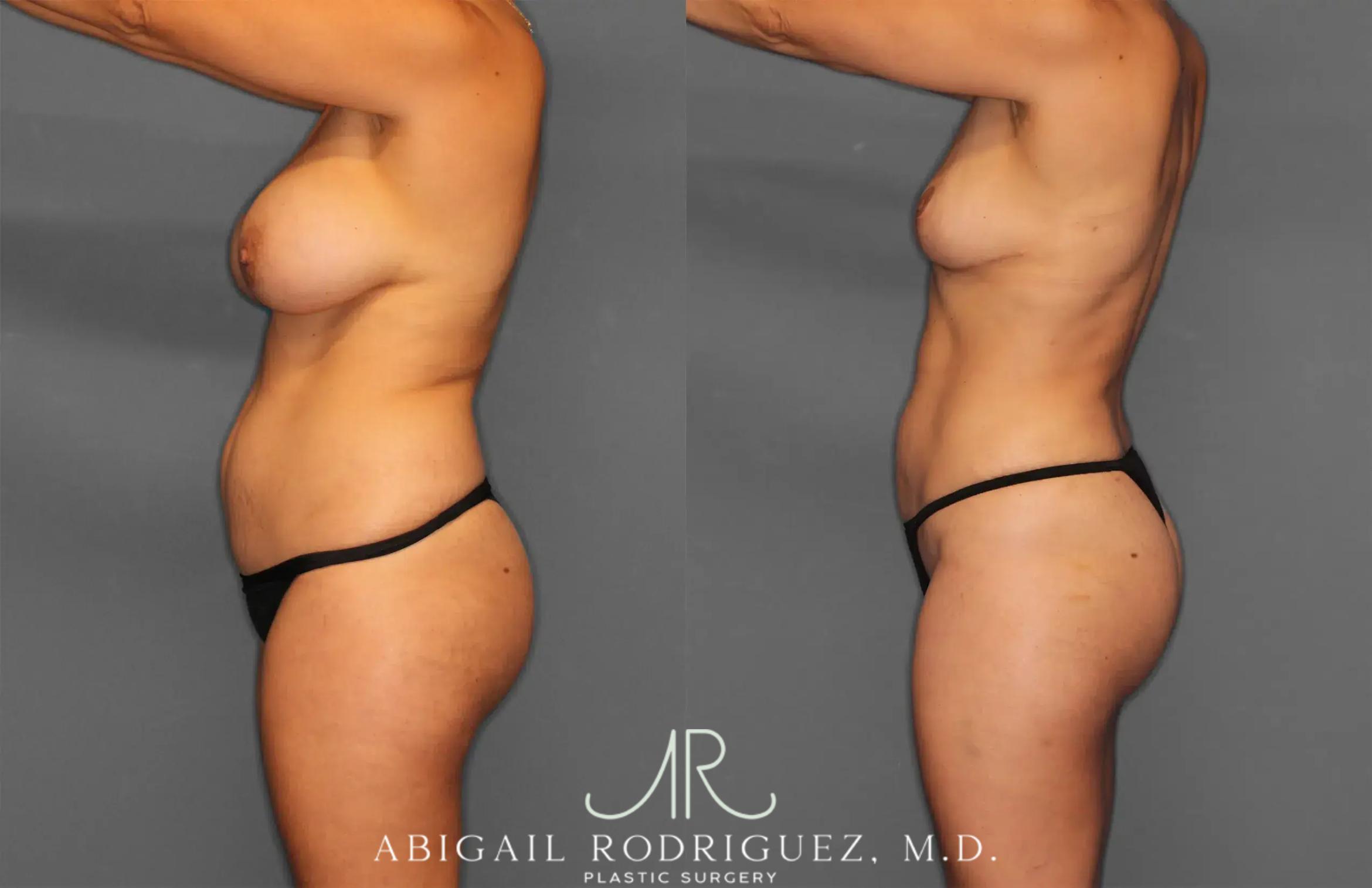 Before & After Renuvion Case 259218 View 3 View in Houston, TX