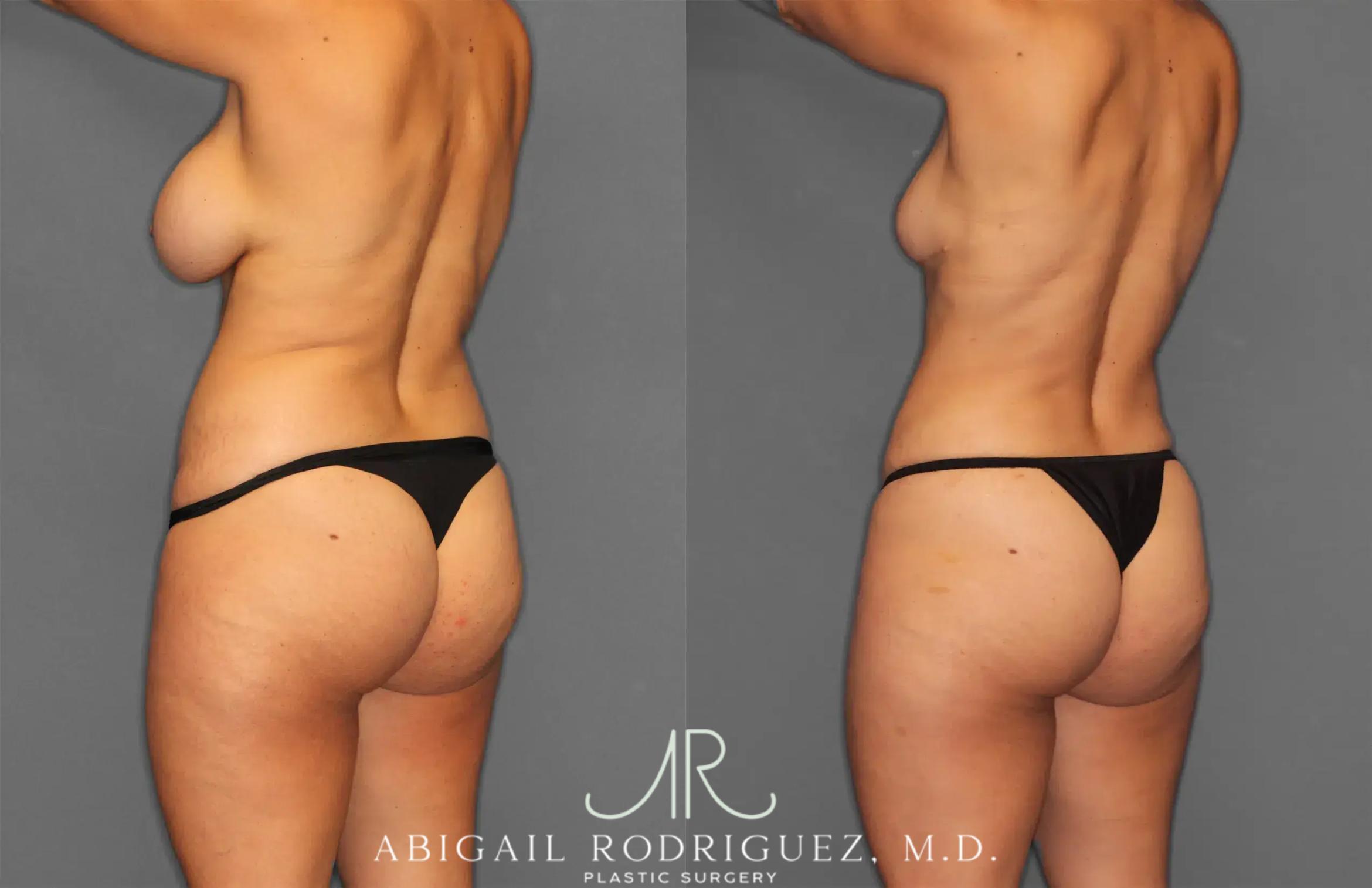 Before & After Renuvion Case 259218 View 4 View in Houston, TX