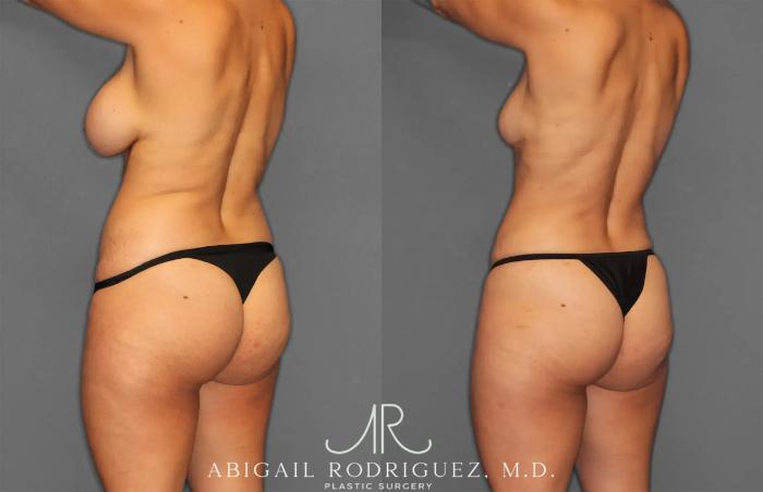Before & After Renuvion Case 259218 View 4 View in Houston, TX