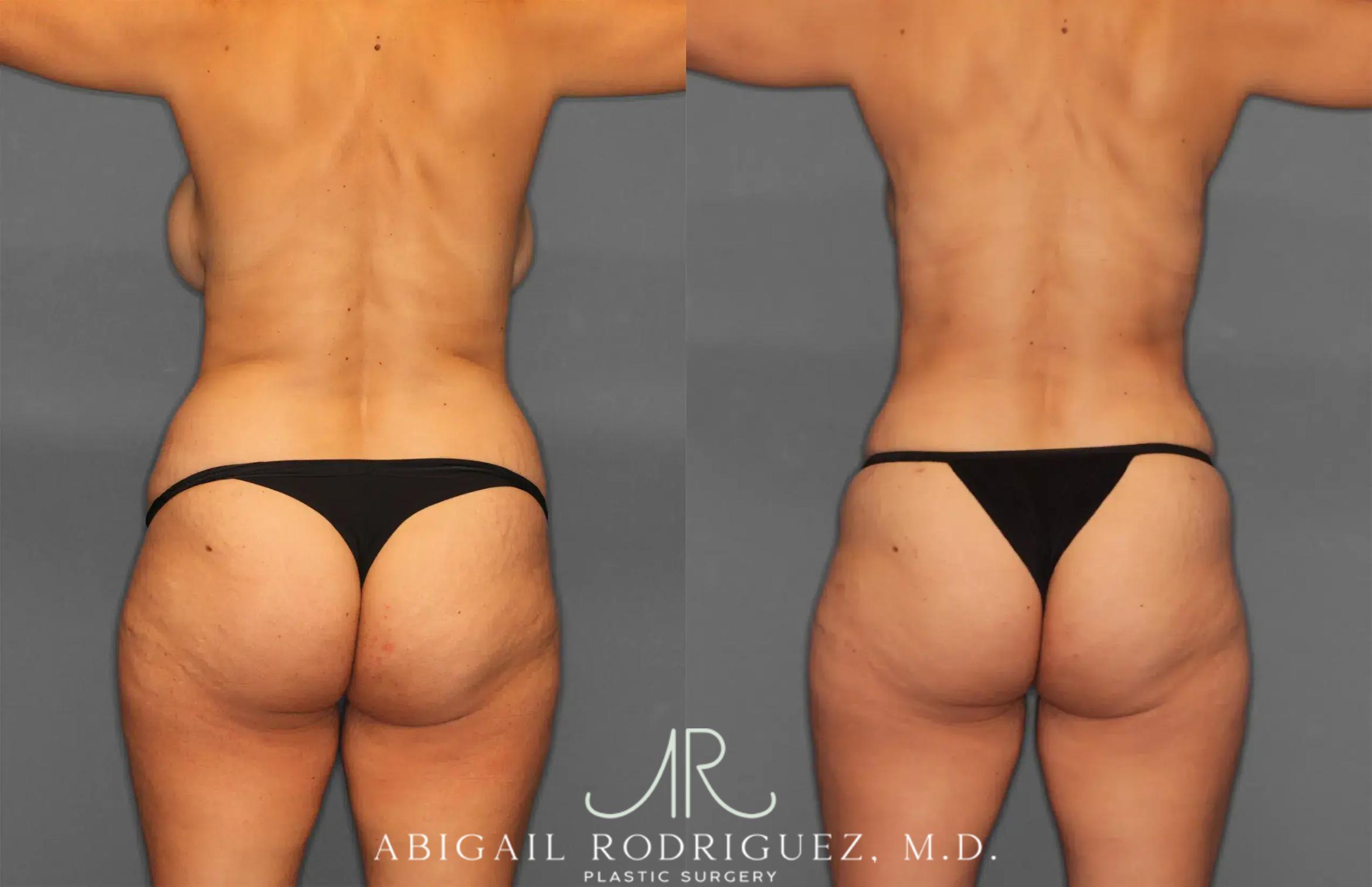 Before & After Renuvion Case 259218 View 5 View in Houston, TX