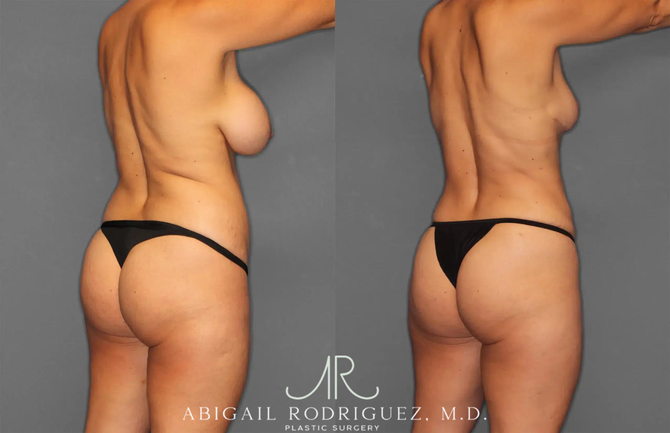 Before & After Renuvion Case 259218 View 6 View in Houston, TX