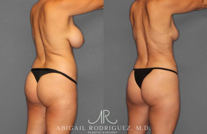 Before & After Renuvion Case 259218 View 6 View in Houston, TX