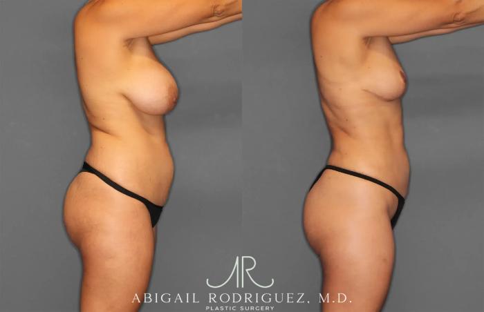 Before & After Renuvion Case 259218 View 7 View in Houston, TX