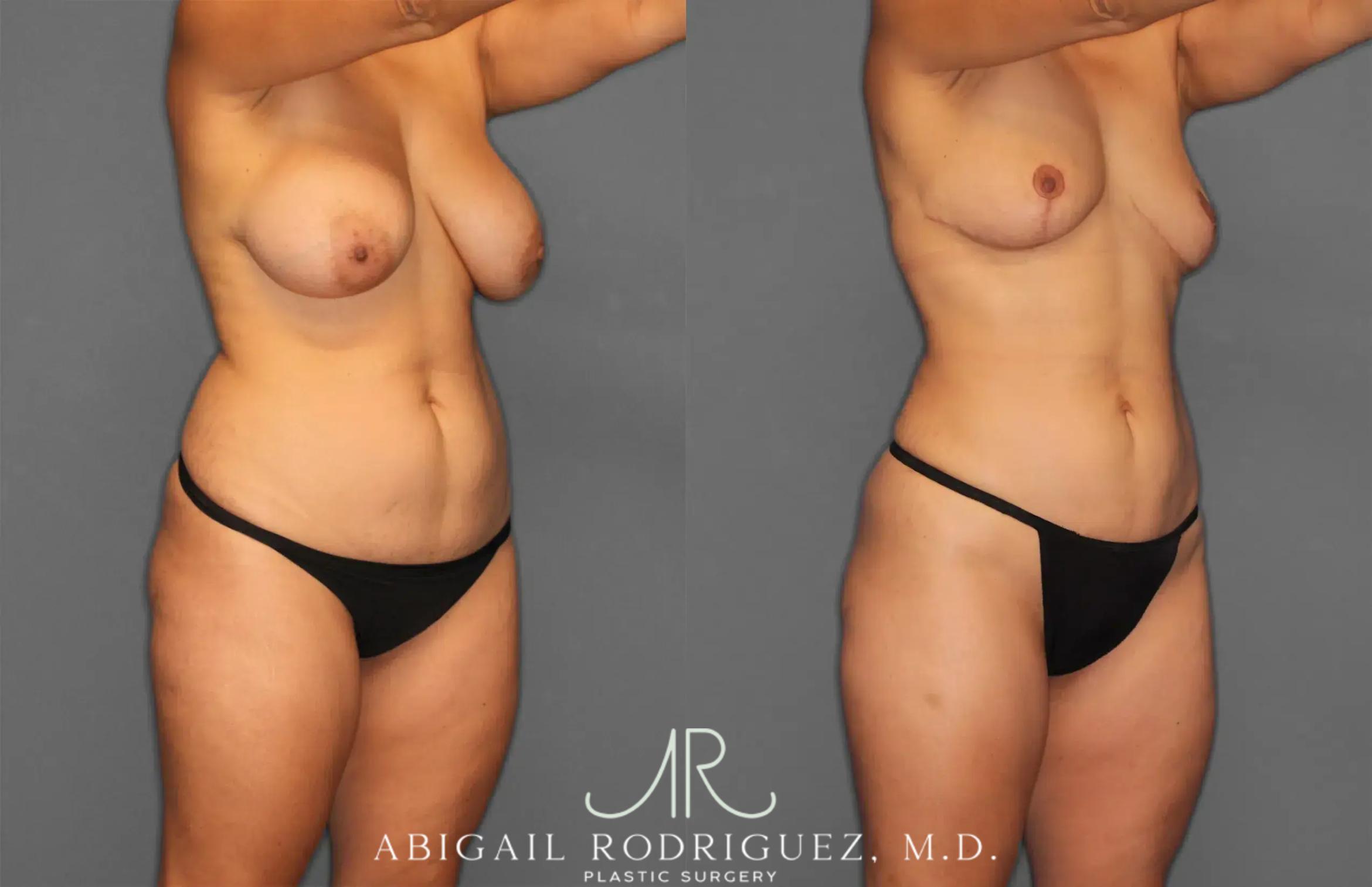 Before & After Renuvion Case 259218 View 8 View in Houston, TX