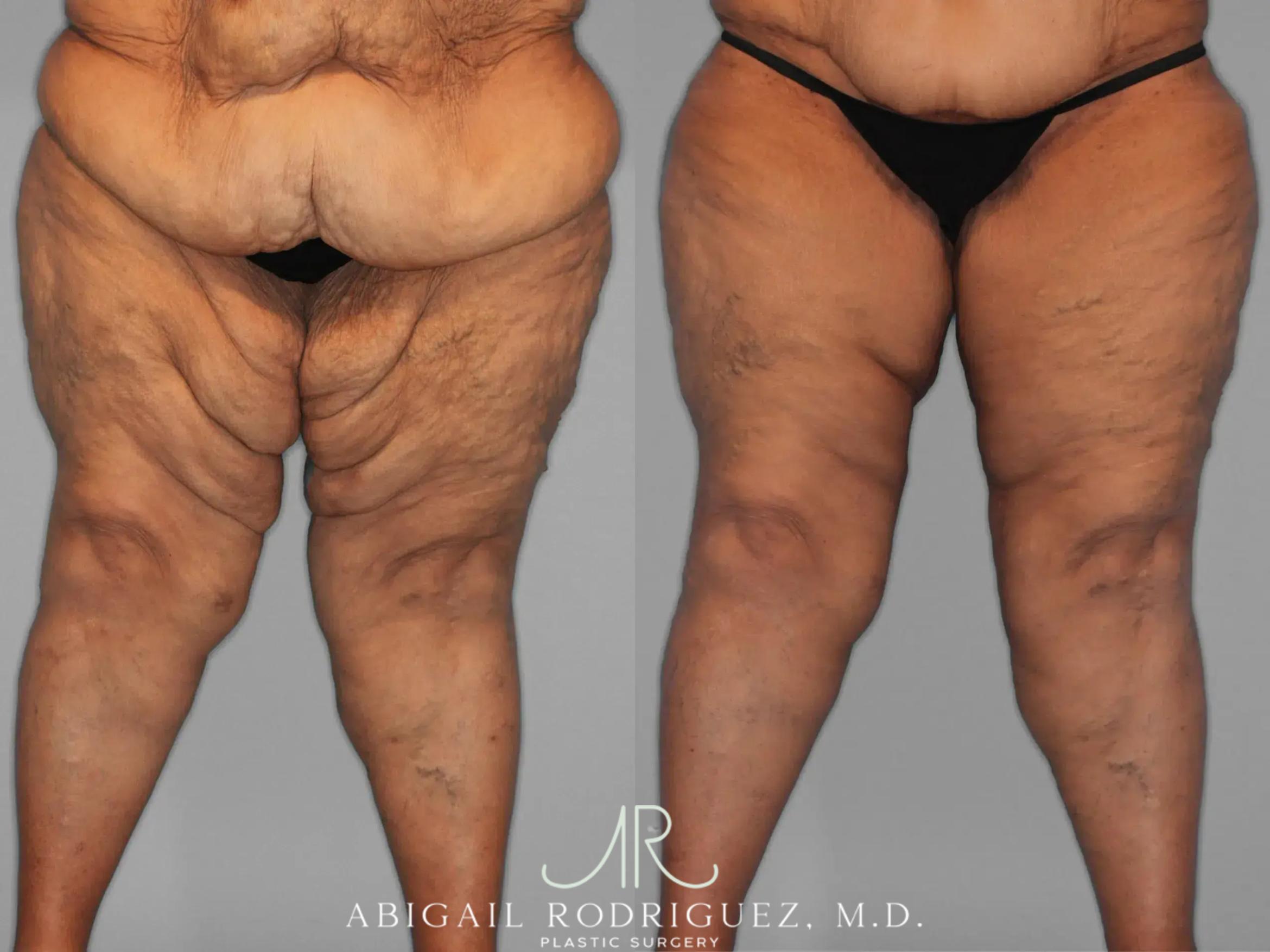 Before & After Thigh Lift Case 259429 View 1 View in Houston, TX