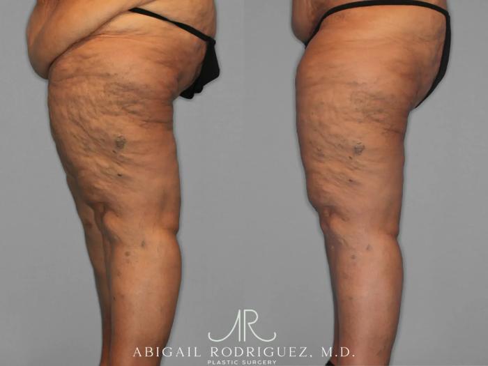 Before & After Thigh Lift Case 259429 View 2 View in Houston, TX