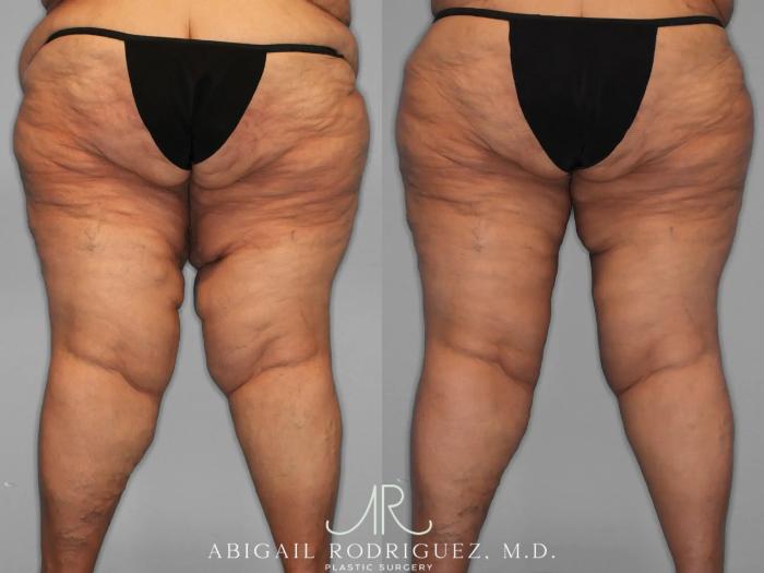 Before & After Thigh Lift Case 259429 View 3 View in Houston, TX