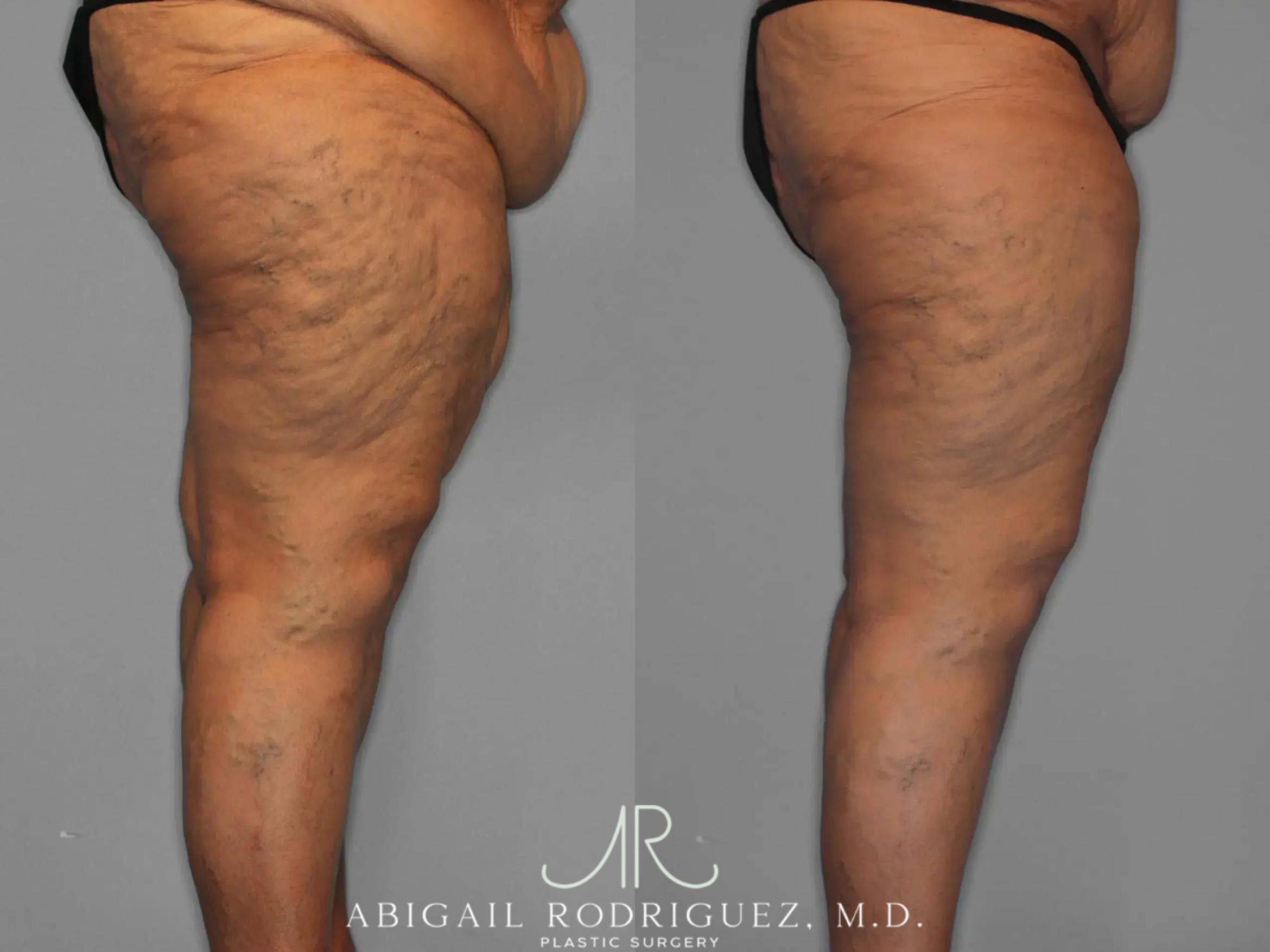 Before & After Thigh Lift Case 259429 View 4 View in Houston, TX