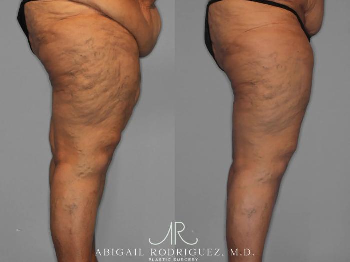 Before & After Thigh Lift Case 259429 View 4 View in Houston, TX