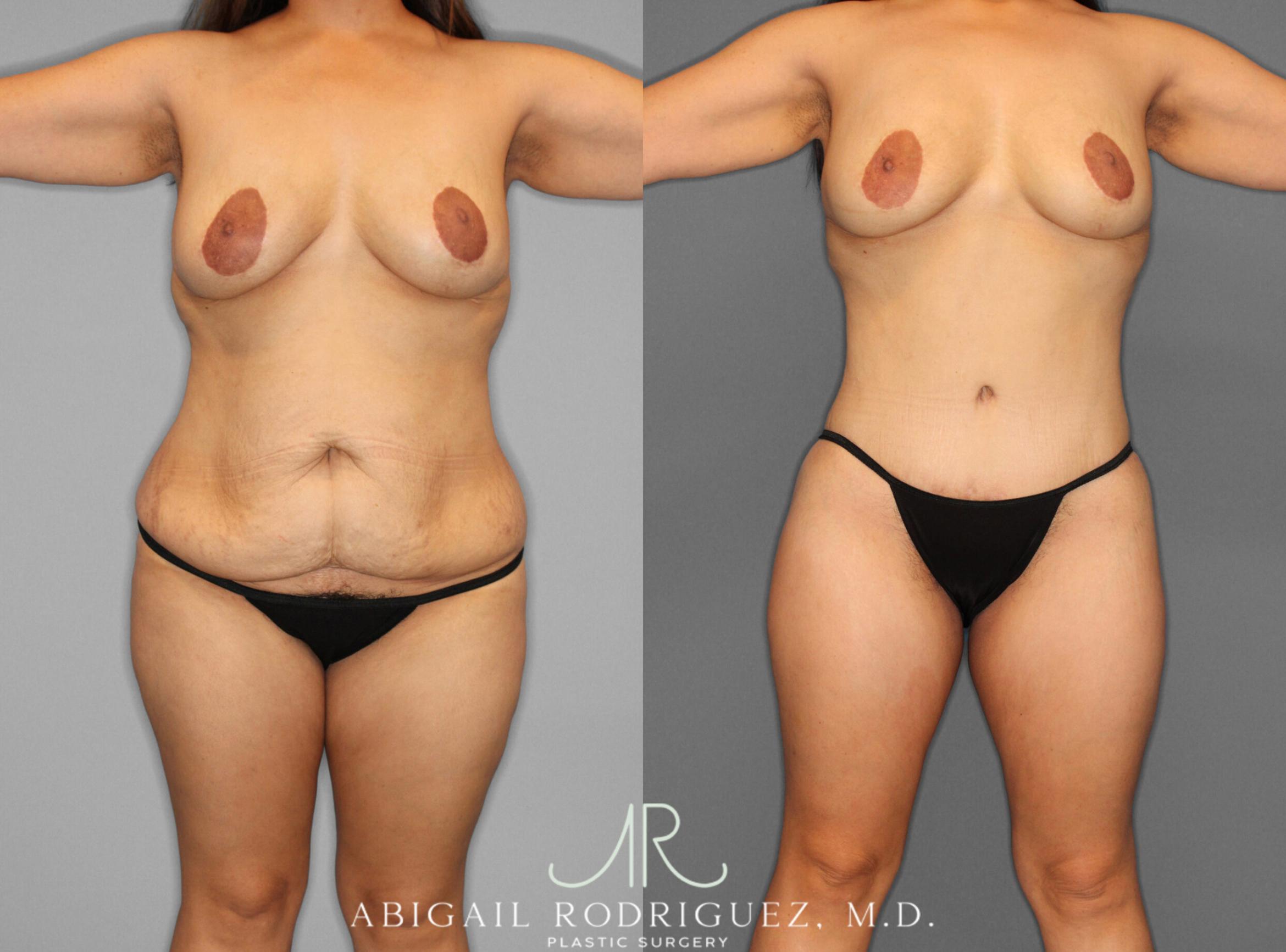 Before & After Tummy Tuck Case 153243 View 1 View in Houston, TX