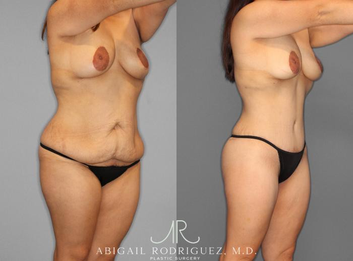 Before & After Tummy Tuck Case 153243 View 2 View in Houston, TX