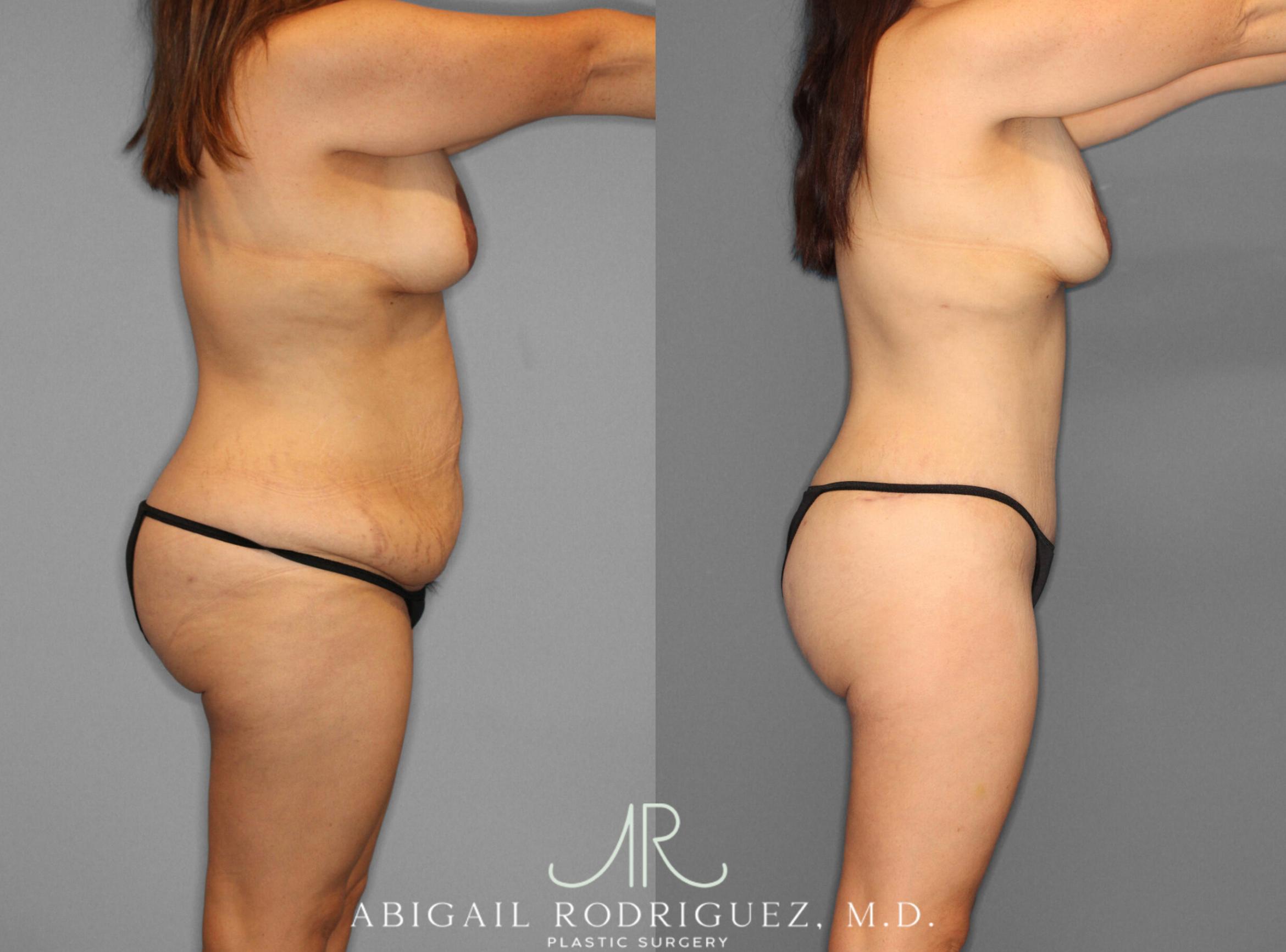 Before & After Tummy Tuck Case 153243 View 3 View in Houston, TX