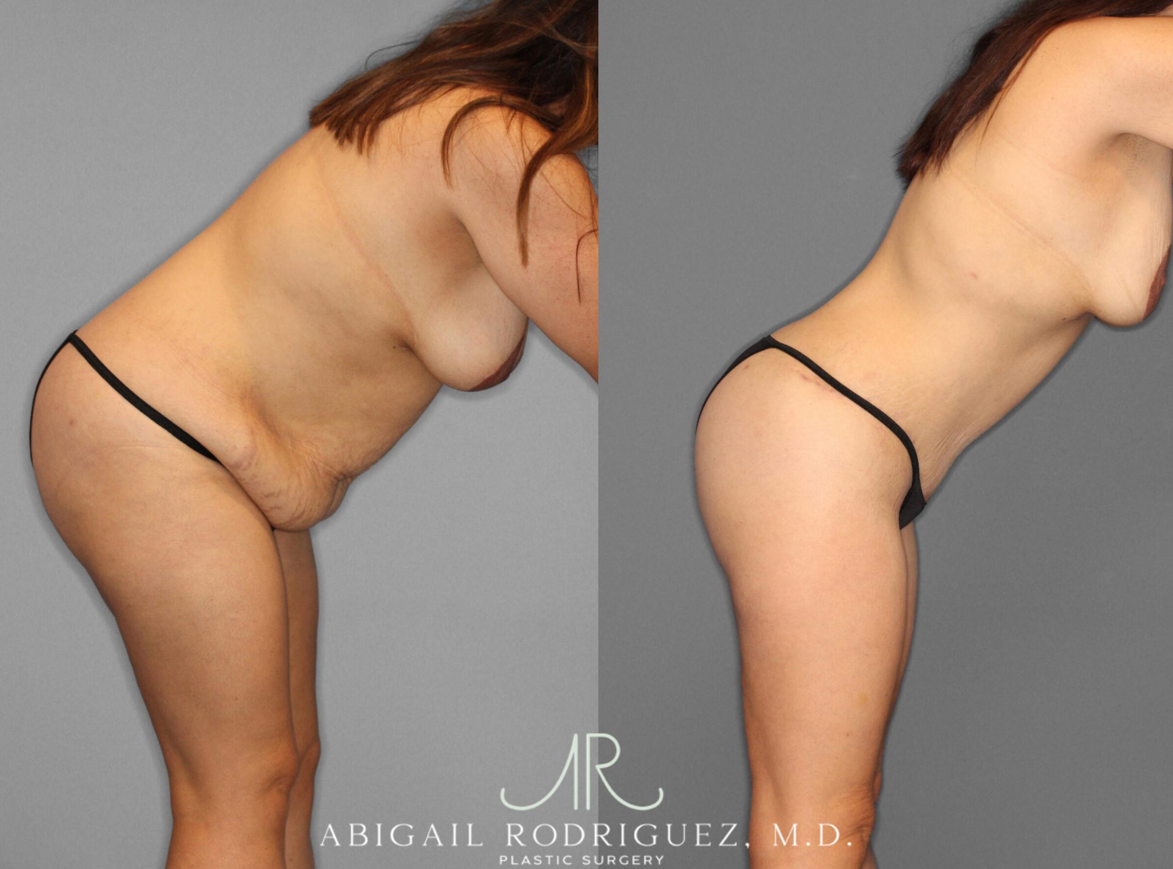 Before & After Tummy Tuck Case 153243 View 4 View in Houston, TX