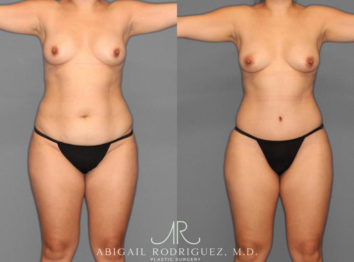 Before & After Tummy Tuck Case 253945 View 1 View in Houston, TX