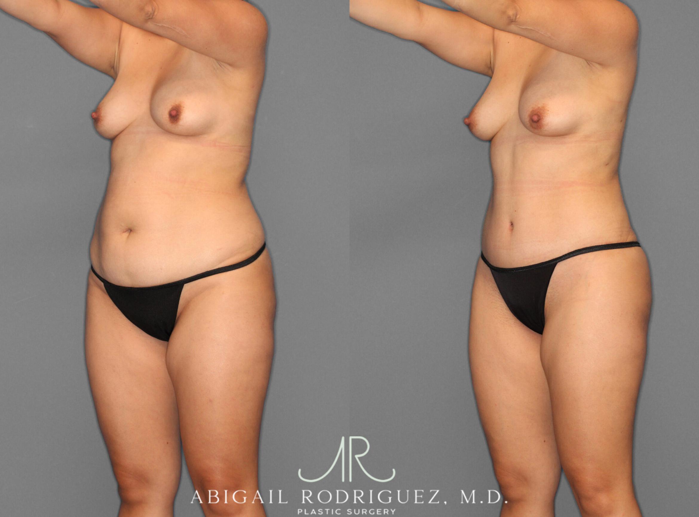 Before & After Tummy Tuck Case 253945 View 2 View in Houston, TX