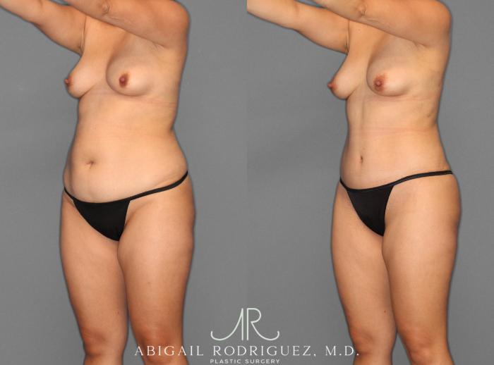 Before & After Tummy Tuck Case 253945 View 2 View in Houston, TX